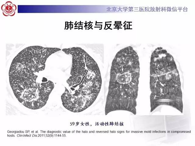 【PPT】晕征与反晕征