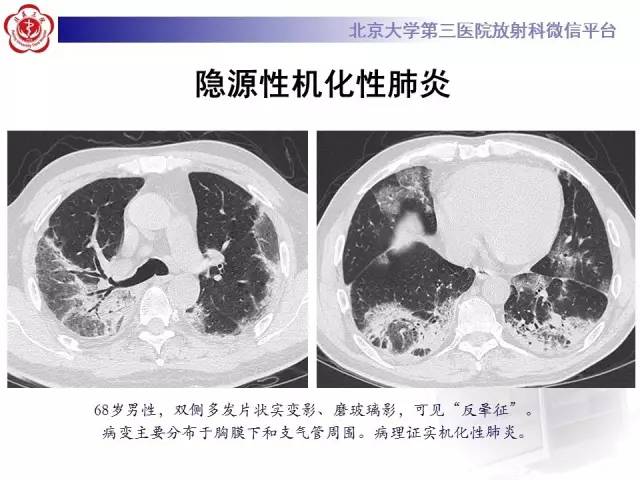 【PPT】晕征与反晕征