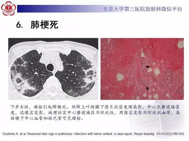 【PPT】晕征与反晕征