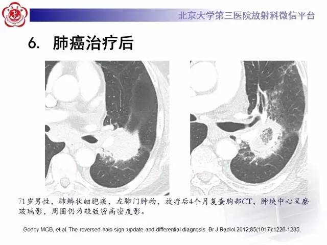 【PPT】晕征与反晕征