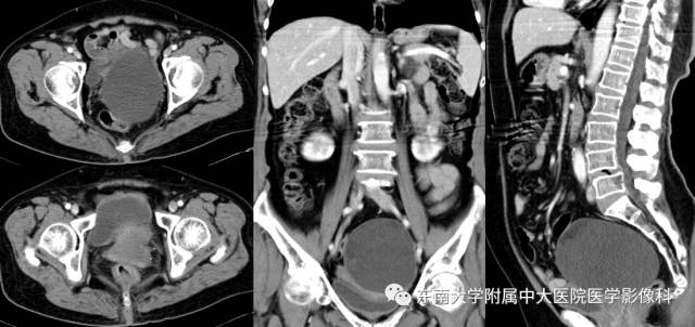 【病例】卵巢畸胎瘤2例CT