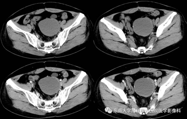【病例】卵巢畸胎瘤2例CT