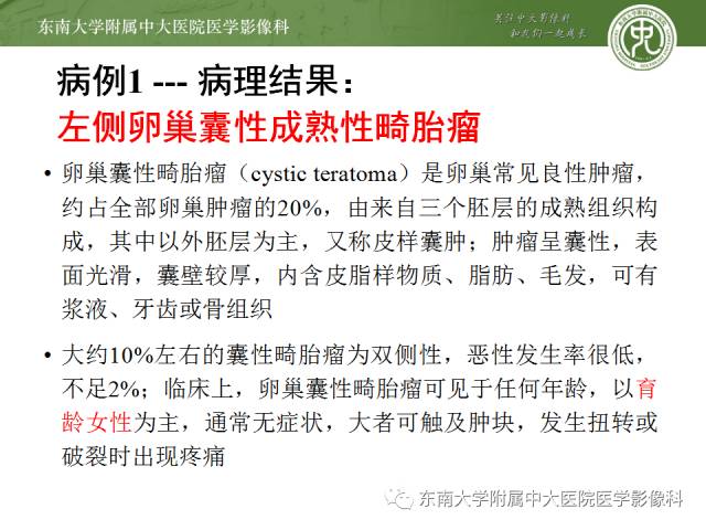 【病例】卵巢畸胎瘤2例CT
