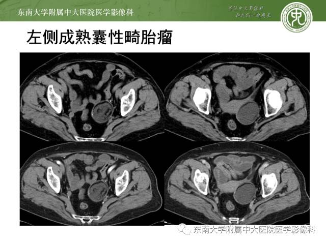【病例】卵巢畸胎瘤2例CT