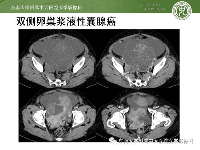 【病例】卵巢畸胎瘤2例CT