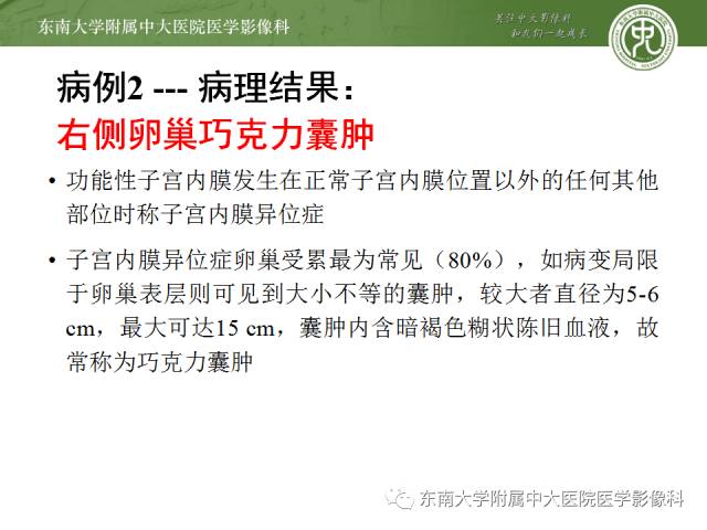 【病例】卵巢畸胎瘤2例CT