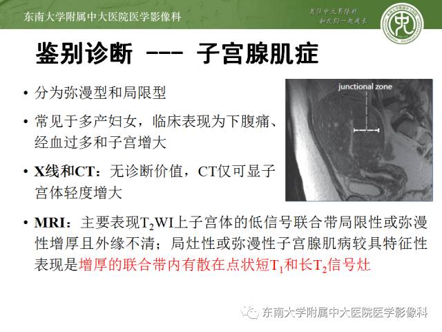 【病例】卵巢畸胎瘤2例CT