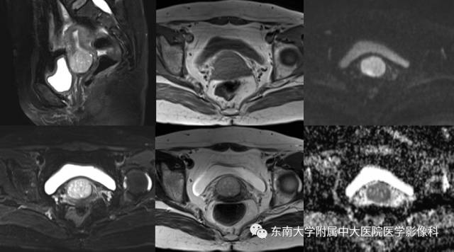 【病例】宫颈浆液性腺癌1例MR