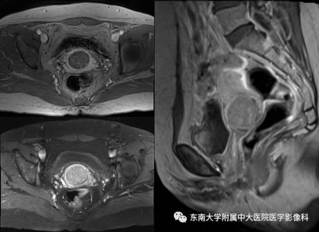 【病例】宫颈浆液性腺癌1例MR