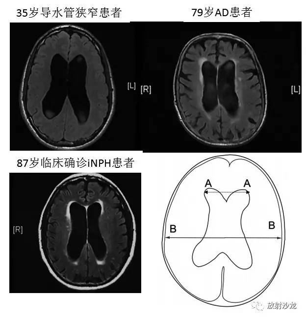特发性正常压力性脑积水iNPH 特发性正常压力性脑积水iNPH