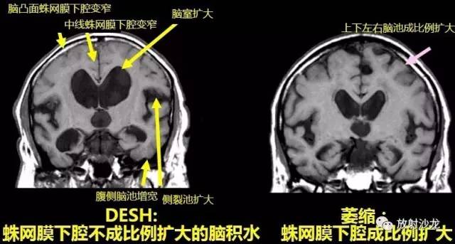 特发性正常压力性脑积水iNPH