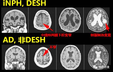 特发性正常压力性脑积水iNPH 特发性正常压力性脑积水iNPH
