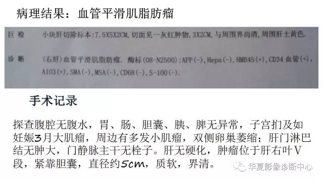 【病例】肝脏血管平滑肌脂肪瘤1例CT影像表现