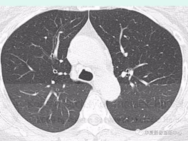 【病例】气管支气管淀粉样变性1例CT
