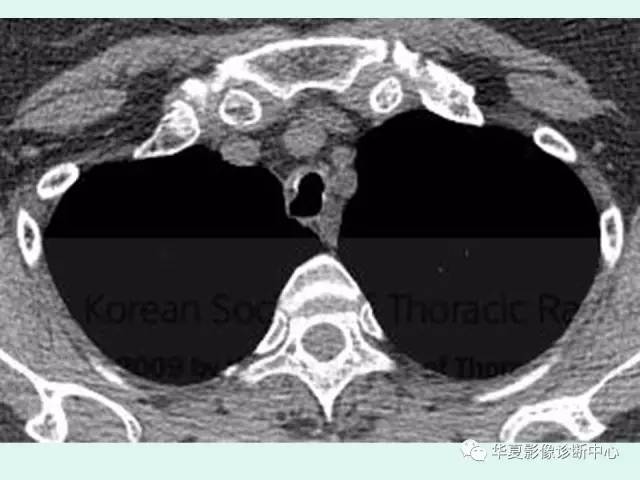 【病例】气管支气管淀粉样变性1例CT