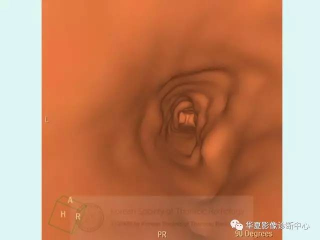 【病例】气管支气管淀粉样变性1例CT