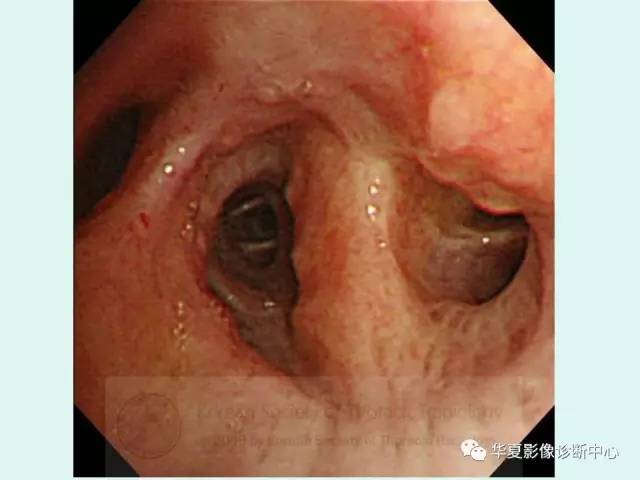 【病例】气管支气管淀粉样变性1例CT