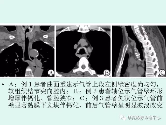 【病例】气管支气管淀粉样变性1例CT