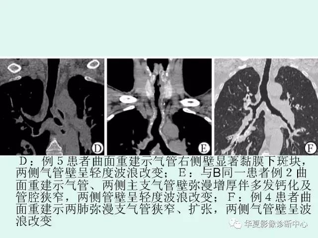 【病例】气管支气管淀粉样变性1例CT
