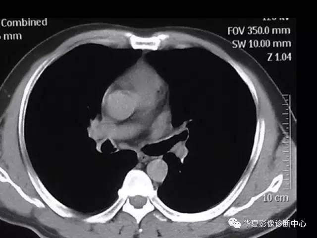 【病例】气管支气管淀粉样变性1例CT