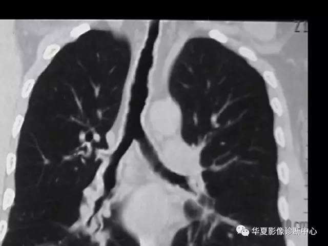 【病例】气管支气管淀粉样变性1例CT