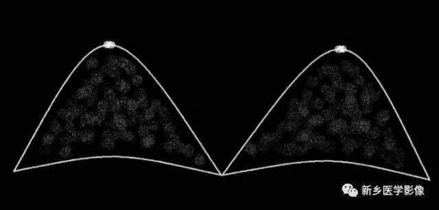 乳腺的24种强化形式与疾病对照