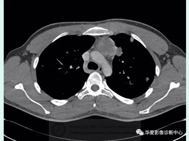 【病例】原发性纵膈绒毛膜癌1例CT