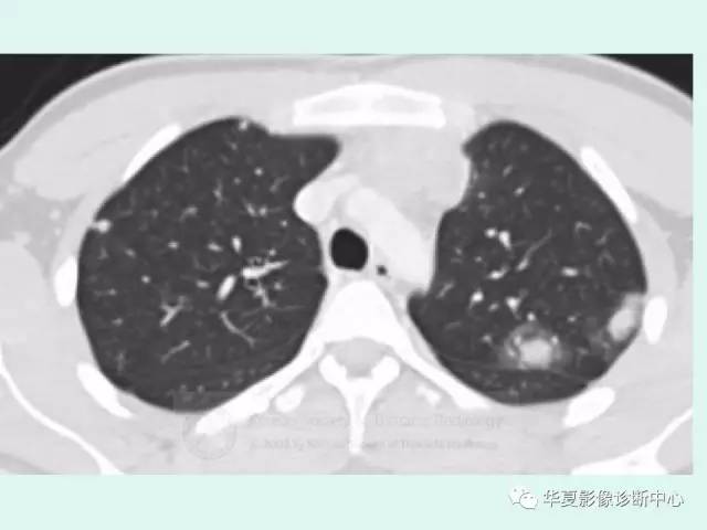 【病例】原发性纵膈绒毛膜癌1例CT