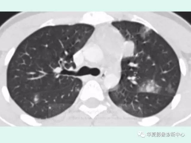 【病例】原发性纵膈绒毛膜癌1例CT