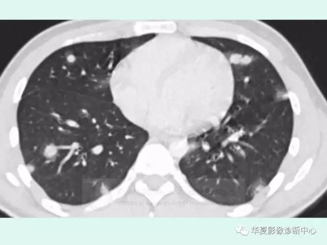 【病例】原发性纵膈绒毛膜癌1例CT