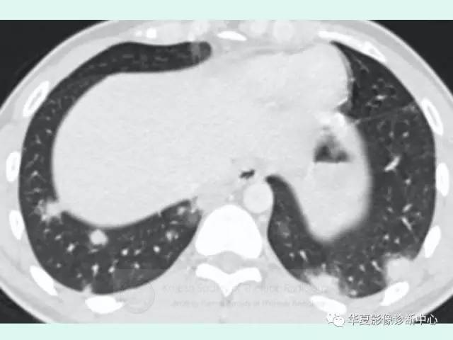 【病例】原发性纵膈绒毛膜癌1例CT