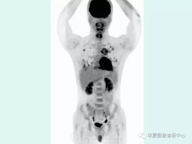 【病例】原发性纵膈绒毛膜癌1例CT