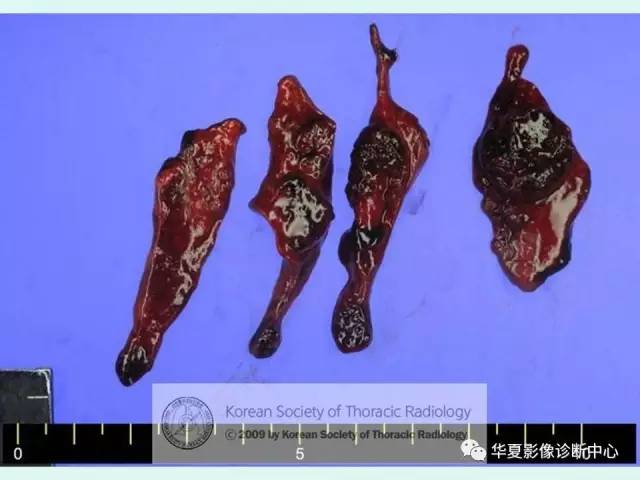 【病例】原发性纵膈绒毛膜癌1例CT
