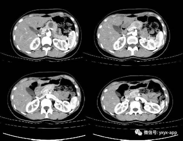 【病例】胰腺实性假乳头状瘤1例CT