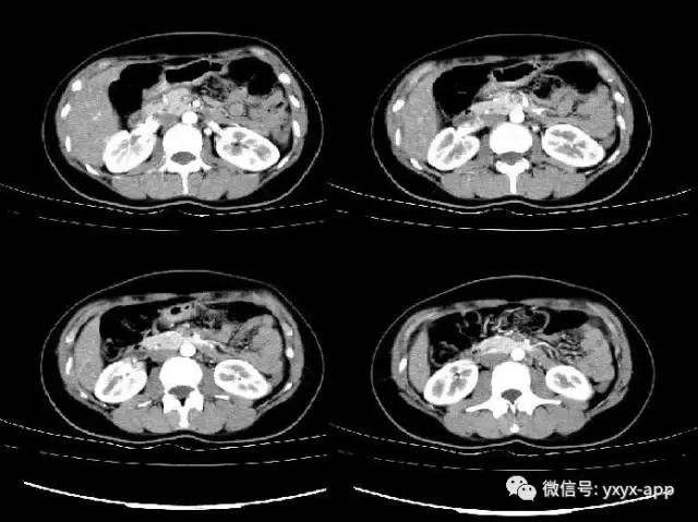【病例】胰腺实性假乳头状瘤1例CT 【病例】胰腺实性假乳头状瘤1例CT