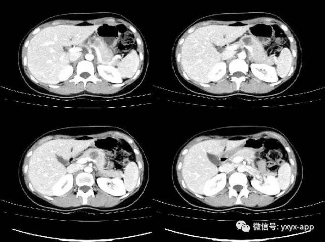 【病例】胰腺实性假乳头状瘤1例CT 【病例】胰腺实性假乳头状瘤1例CT