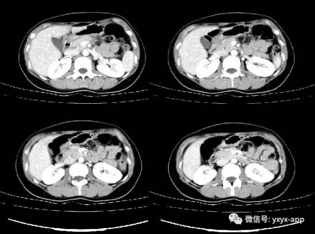 【病例】胰腺实性假乳头状瘤1例CT 【病例】胰腺实性假乳头状瘤1例CT