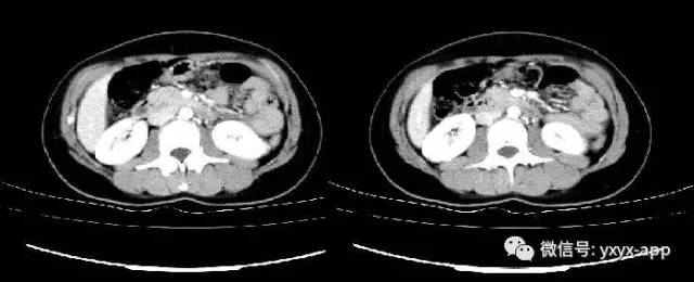 【病例】胰腺实性假乳头状瘤1例CT 【病例】胰腺实性假乳头状瘤1例CT