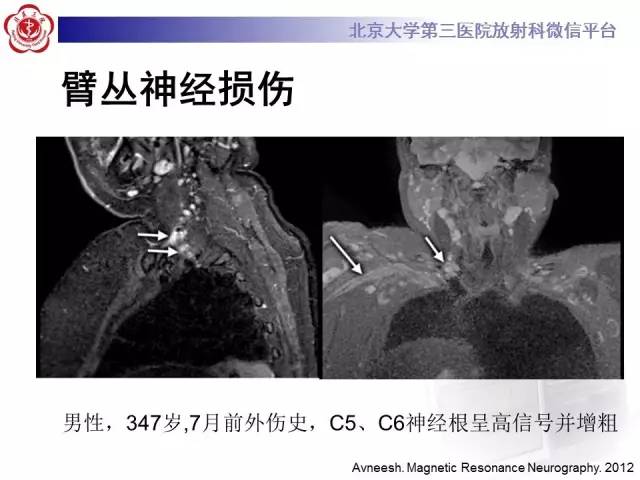 【PPT】臂丛神经