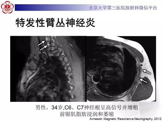【PPT】臂丛神经