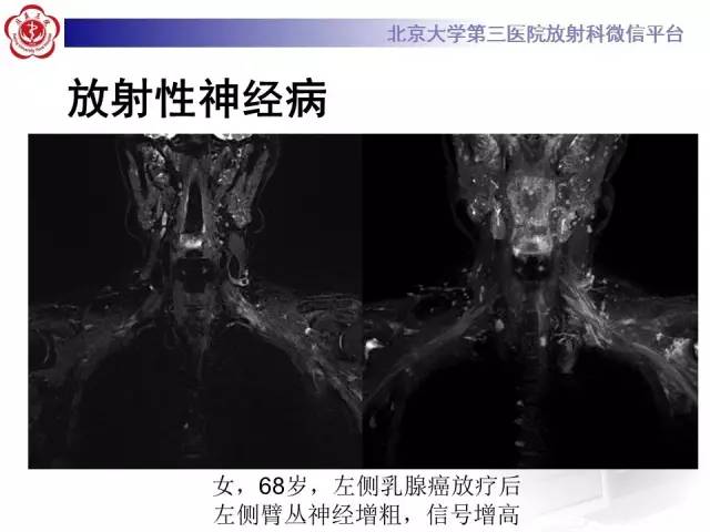 【PPT】臂丛神经