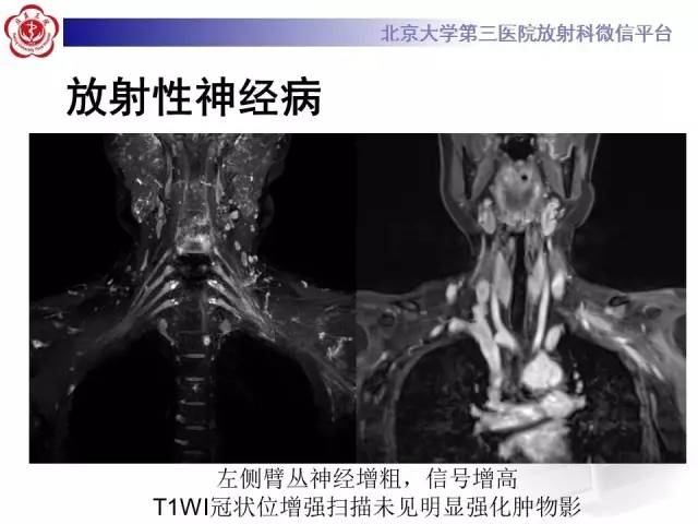 【PPT】臂丛神经
