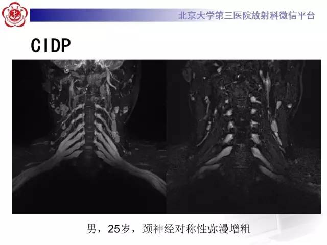 【PPT】臂丛神经