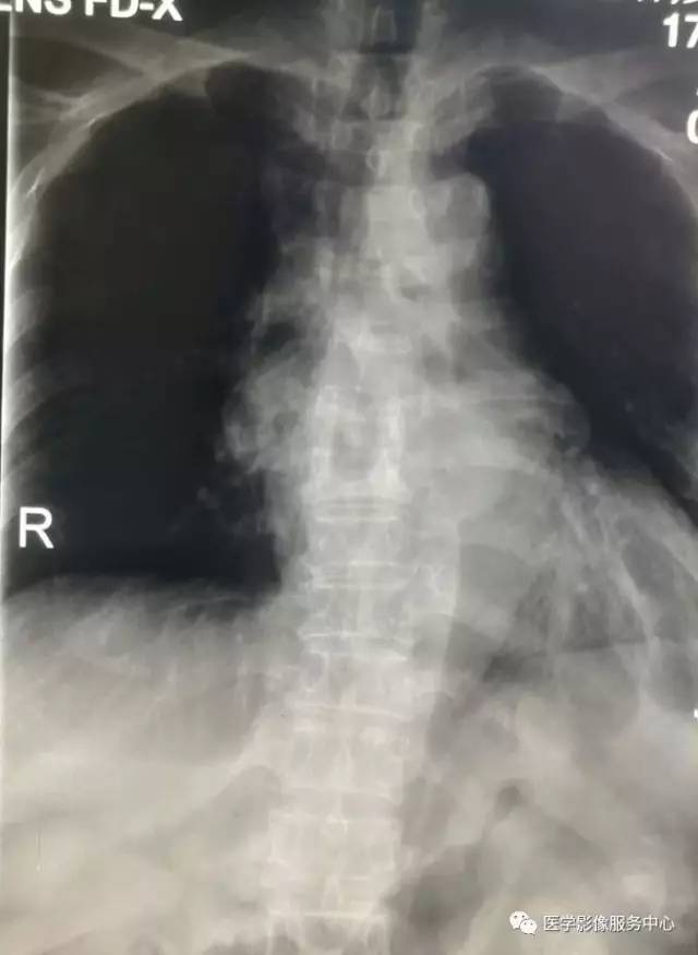 【病例】胸椎结核1例X线CT及MR影像表现 【病例】胸椎结核1例X线CT及MR影像表现