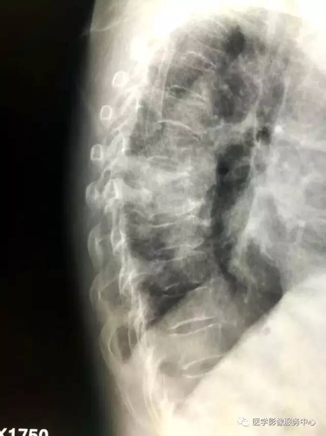 【病例】胸椎结核1例X线CT及MR影像表现 【病例】胸椎结核1例X线CT及MR影像表现
