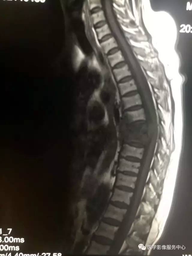 【病例】胸椎结核1例X线CT及MR影像表现