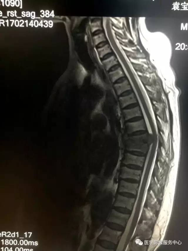 【病例】胸椎结核1例X线CT及MR影像表现 【病例】胸椎结核1例X线CT及MR影像表现