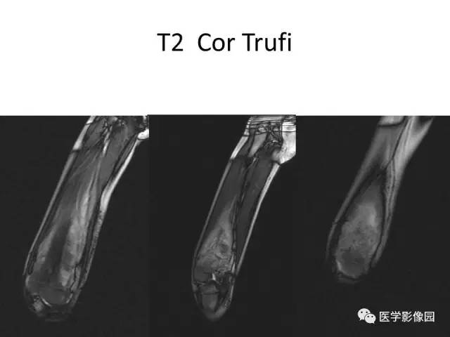 【病例】股骨骨肉瘤1例MR