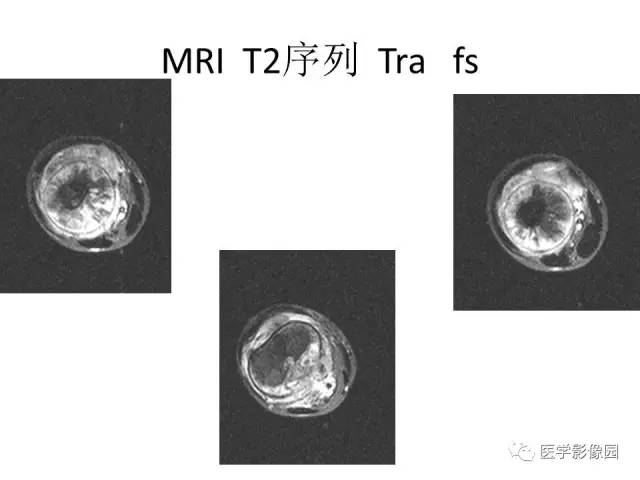 【病例】股骨骨肉瘤1例MR