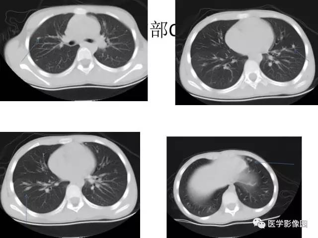 【病例】股骨骨肉瘤1例MR